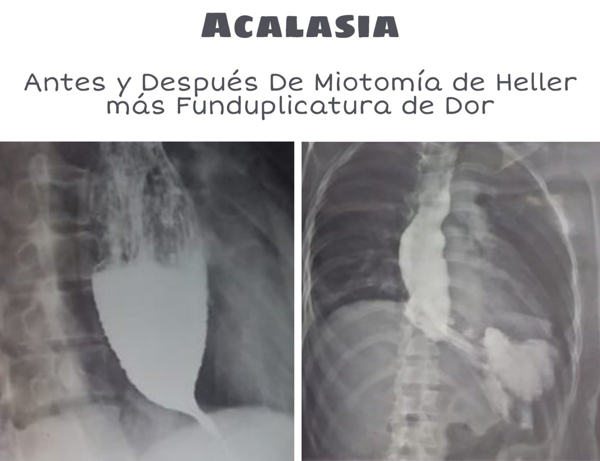 #acalasia antes y después de #miotomia de #Heller y funduplicatura de #Dor
Notable mejoría de los síntomas 
#LoQueNosGusta
