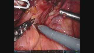 AAGL's tweet photo. #Endometriosis can involve the rectovaginal septum. When it involves the rectum, discoid resection can sometimes be possible. Watch this #SurgeryU #SurgeryNew video to learn the technique to complete this procedure.
https://t.co/vFlEGYf2hI https://t.co/na5gjnbnLB