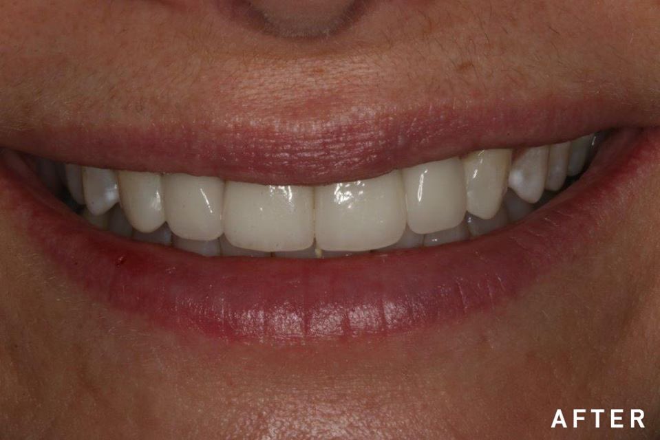 BEFORE + AFTER

In this case I replaced old chipped bonding with  porcelain veneers on 4 front teeth and I used direct composite resin to restore her canines. The result gave her a beautiful smile! 

Thank you to Valley Dental Arts!

#smile #smiles #smiling #cosmeticdentistry
