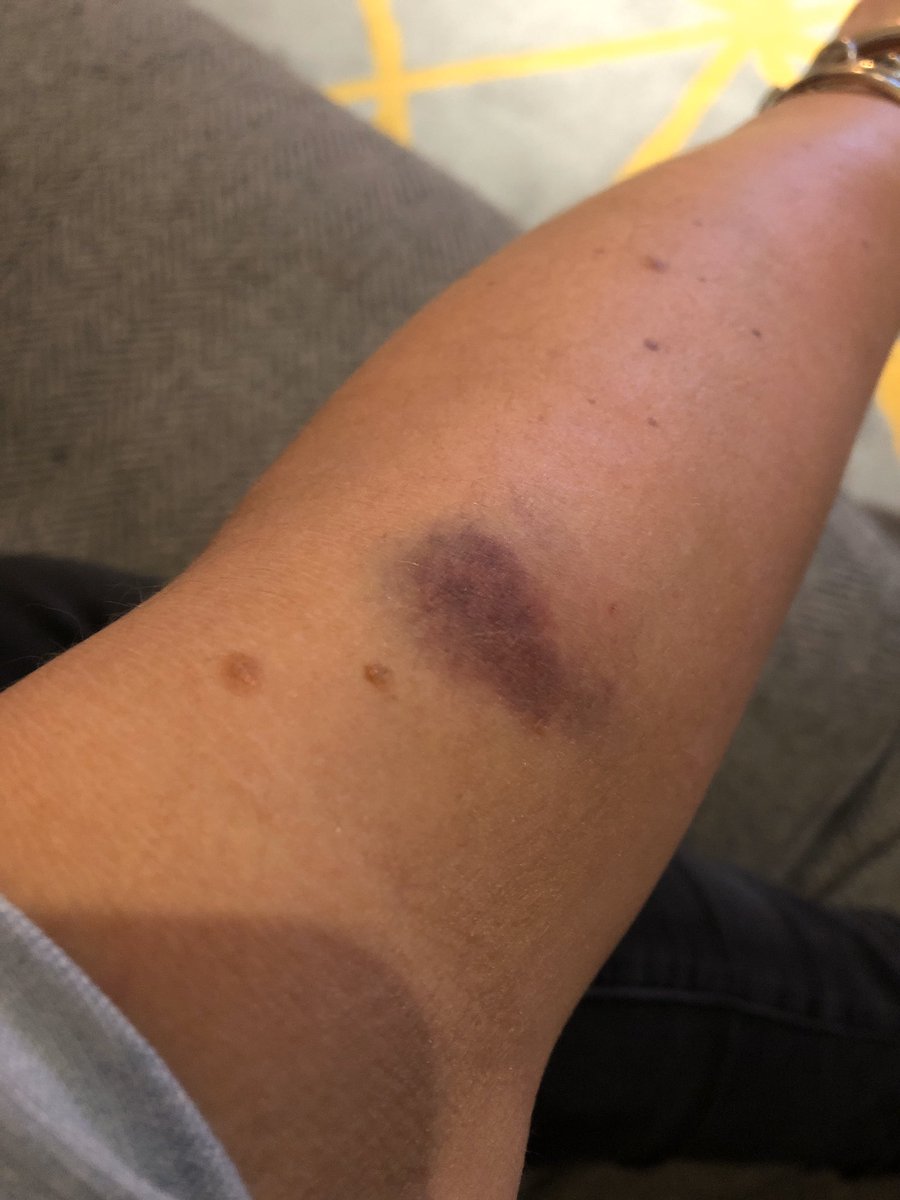 sarah_church's tweet image. Turns out I bruise like a peach 🍑 
#bruise #peach #delicateflower
