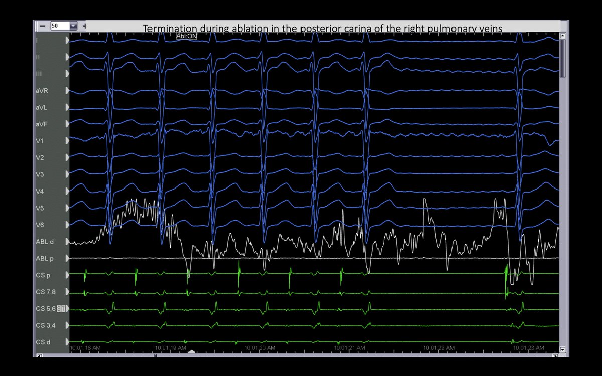 FrischMd's tweet image. This pt with atypical AFL had a prior surgical abl at the time of MV repair. The CS d-&amp;gt;p EGMs suggested a lateral LA source, but 3D activation had RPV carina in the circuit…which was the abl site! #mapmoreburnless @JoshSellke @maddyferraro1 @arcampado