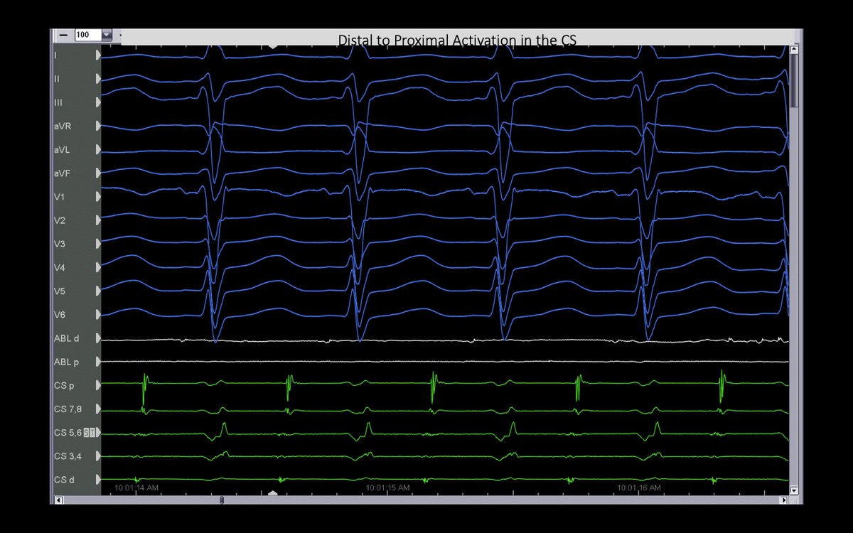 FrischMd's tweet image. This pt with atypical AFL had a prior surgical abl at the time of MV repair. The CS d-&amp;gt;p EGMs suggested a lateral LA source, but 3D activation had RPV carina in the circuit…which was the abl site! #mapmoreburnless @JoshSellke @maddyferraro1 @arcampado