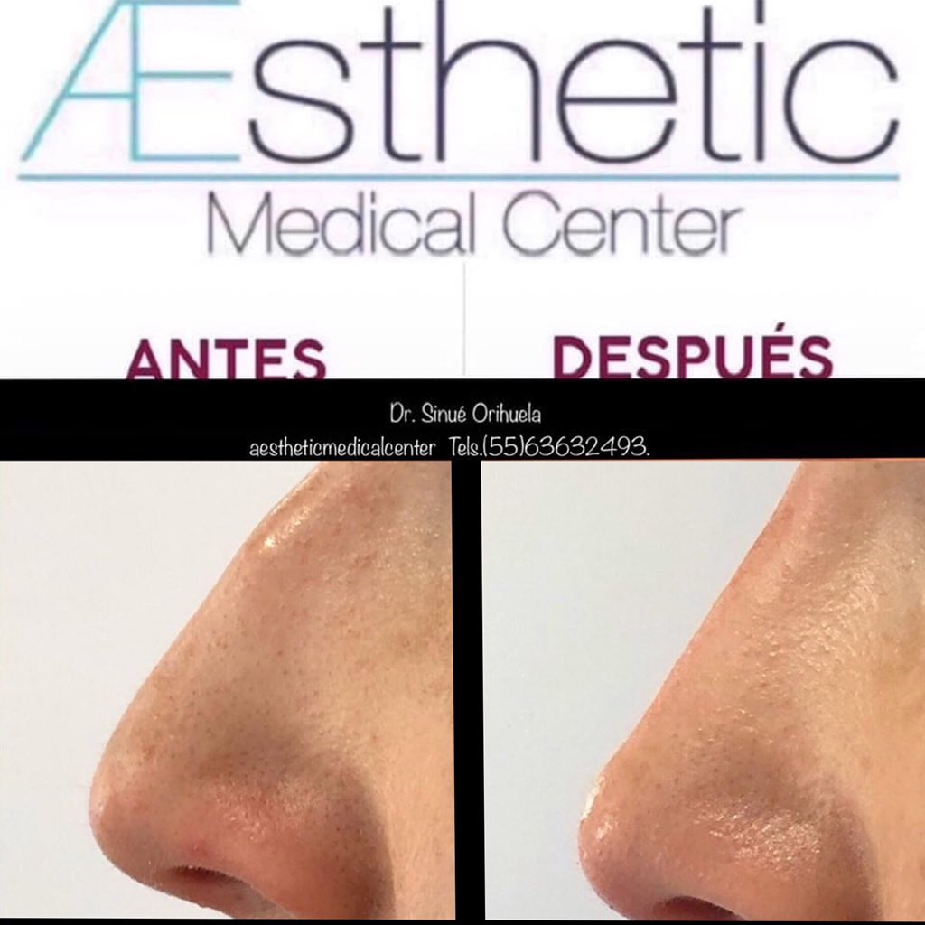 AestheticMC's tweet photo. #Rinomodelación, consiste en modelar o perfilar la #nariz, con un material de relleno #AcidoHialurónico de alta densidad.
#facelift #medicinaestetica #rejuvecimiento #paraellosyellas #rinomodelacionsincirugia #fillers #rellenosfaciles #liftingfacial #fitness https://t.co/m5pjO2uXaQ