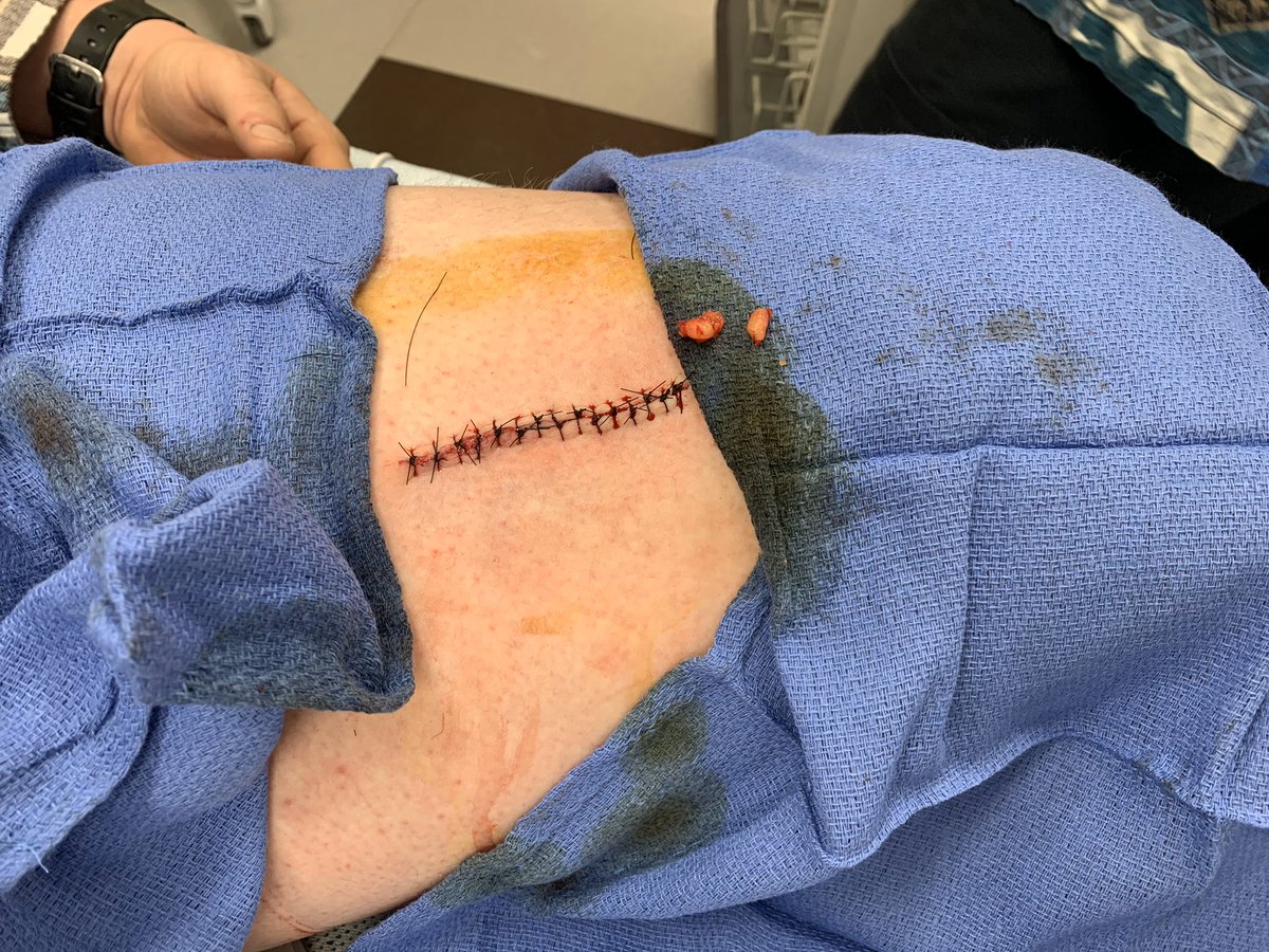 WillisCollin's tweet photo. Well I had a great start to my day today. Thankful that I didn’t hit an artery. After 15 stitches and a lot of pain I’m ok. Thanks to everyone who helped me out today. Hopefully the recovery will be speedy! https://t.co/uH5ndaKfYu