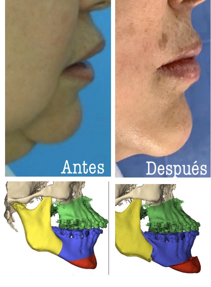 Adrisabogal09's tweet photo. Cirugía Ortognática con planeación virtual!! 

📞 3104289524 - 3799430 Cali, Colombia 🇨🇴 

#adrianasabogalmaxilofacial #sonreir #planeacionvirtual #planeacioncomputarizada #maxilofacial #ortognatica #cirugia #cirugiamaxilofacial #cirugiaprimero #surgeryfirst #maxilofacialcali https://t.co/1gFz1HxygY