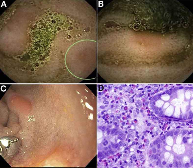 capsulendoscopy's tweet image. @capsulendoscopy Identifies Small Bowel Lesions in
Patients With #Eosinophilic #Enteritis. bit.ly/2wsivHe