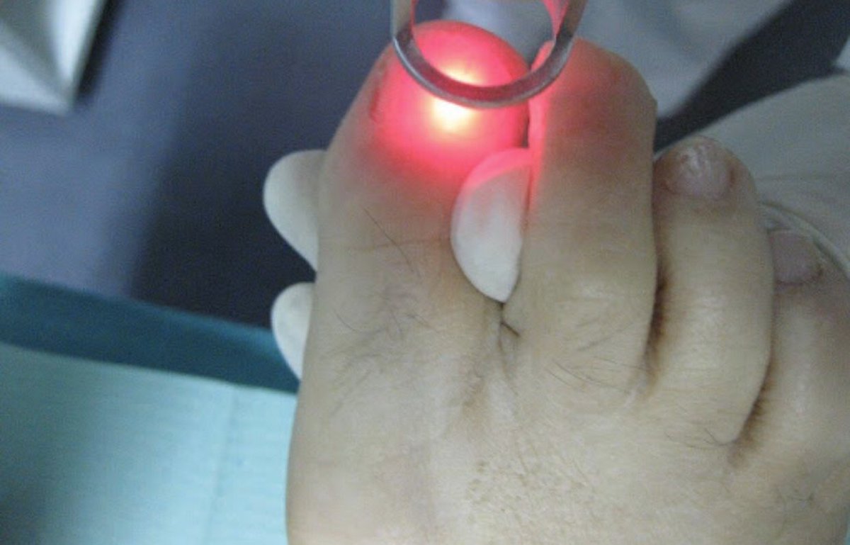 TRATAMIENTO DE ONICOMICOSIS.
La aplicación de láser hace desaparecer tanto al hongo como las esporas,empleando el principio de la fototermólisis selectiva, absorción de la energía láser y conductividad térmica entre la infección fúngica y el tejido.🦶🏻Infórmate!