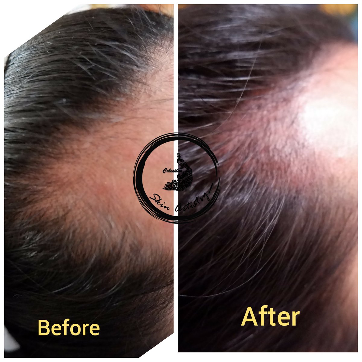 saiartistry's tweet image. #scalppigmentation

-For bald hair/bald spots
-to correct unwanted hairline
#tattoo #alterph #alterpinoy #alterpinay #micropigmentation