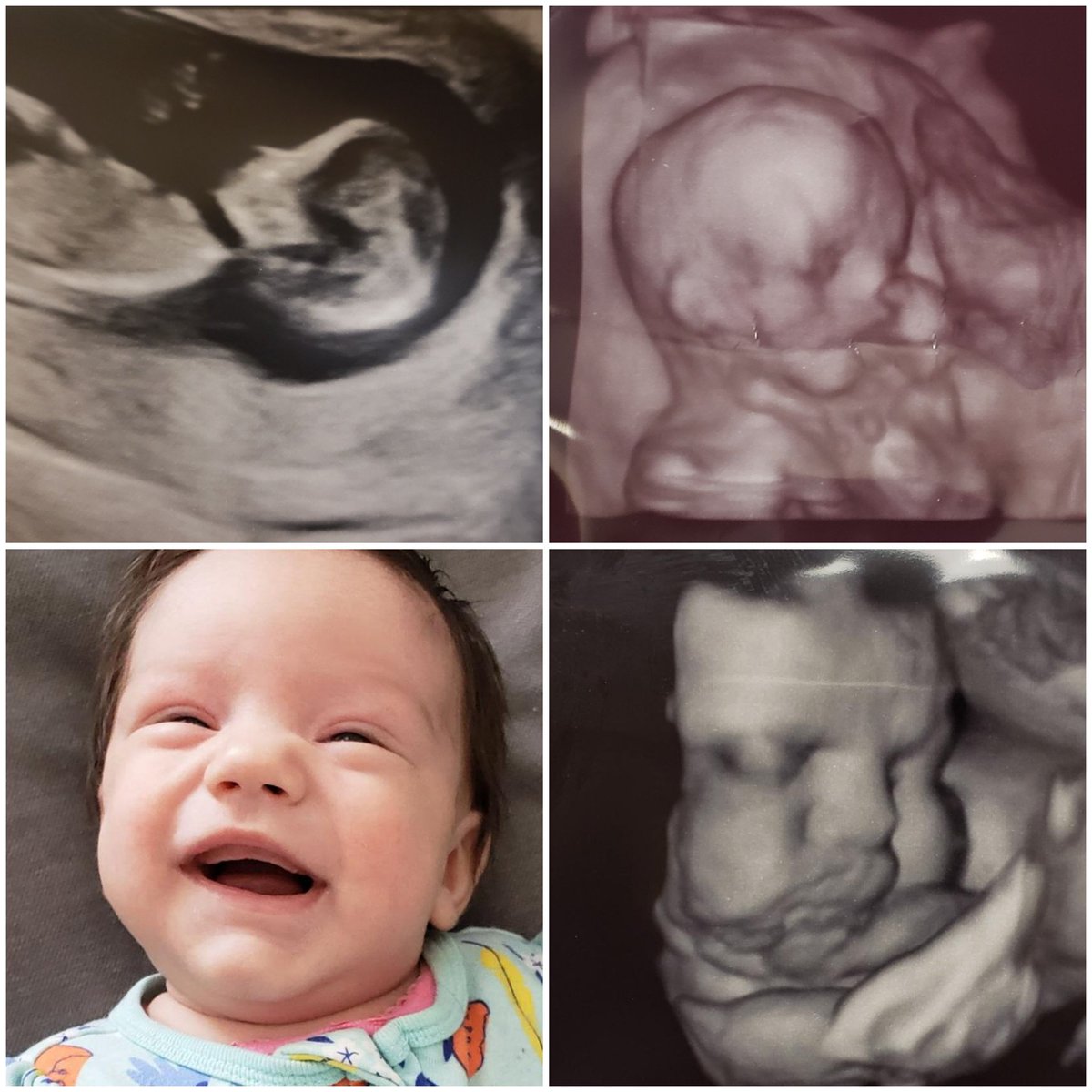 johngacinski's tweet photo. Why am I pro life? Meet my granddaughter! Starting clockwise top left, that's her in June, Aug, Dec & yesterday.
The world would have been fine with killing her at any point up until birth. Thank you Jesus, she is alive & beautiful. How many babies never get this chance? https://t.co/l9lw25V4T1