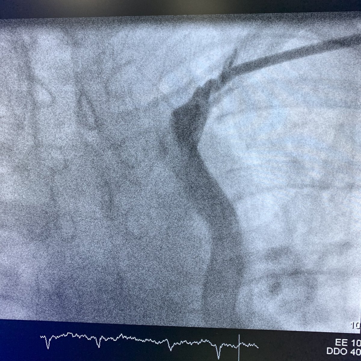 cardiopace's tweet photo. Today’s case:
persistent left superior vena cava #PLSVC #ICD https://t.co/2nysQm7UMk