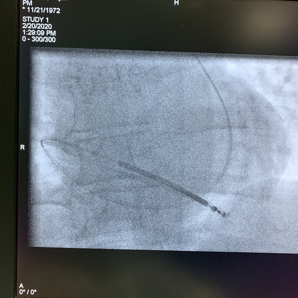 cardiopace's tweet photo. Today’s case:
persistent left superior vena cava #PLSVC #ICD https://t.co/2nysQm7UMk