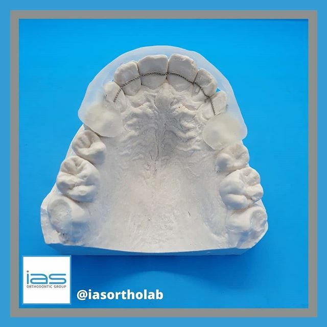 Another stunning bonded retainer smashed out by Atef 💪 
#bondedretainer #dbr #fixedretainer #retainer #dentistry #orthodontics #teeth #smile #happypatient #retention ift.tt/2HGSKoZ