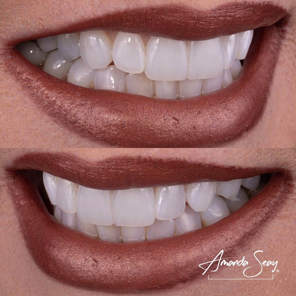 DrAmandaSeay's tweet photo. What I love most about this case is how @regosmiles captured the luster just right! When doing these 1-2 units cases we are always concerned about shade match but often times don’t think about the luster. Not all teeth are glossy! https://t.co/xeKPdpvUnQ