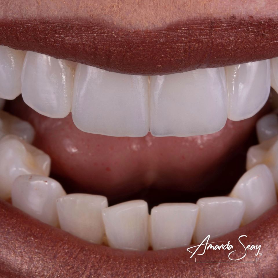 DrAmandaSeay's tweet photo. What I love most about this case is how @regosmiles captured the luster just right! When doing these 1-2 units cases we are always concerned about shade match but often times don’t think about the luster. Not all teeth are glossy! https://t.co/xeKPdpvUnQ
