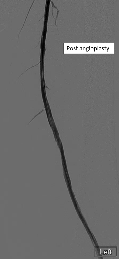53 yo with a non-healing ulcer and #claudication. Angio with mid SFA stenosis with distal reconstitution and 2 vessel runoff. An .018 #Terumo advantage makes quick work to cross the lesion -&gt; POBA/DCB angioplasty = success!

#twittIR #limbsavers #InnovationToHeal #IRad #radiology