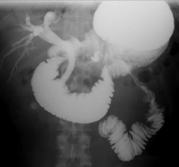 VideoGIE Editor's Choice: 'EUS-guided duodenojejunostomy by use of a 2-cm lumen-apposing metal stent to treat proximal jejunal stricture in a patient with chronic pancreatitis' by Michael Lajin et al. videogie.org/article/S2468-…