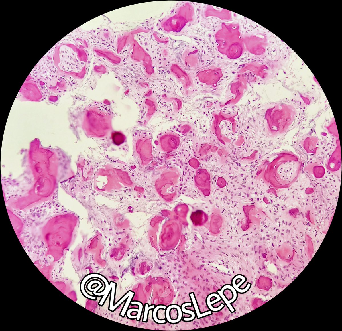 MarcosLepeMD's tweet photo. 🔰 Interesting case of the day 🔰

⚜️ Juvenile psammommatoid ossifying fibroma ⚜️

#pathology #softtissue #stpath #meded #surgicalpath #surgicalpathology

@Andres_Matoso @aakasharmand @smlungpathguy @md_kyle @Sara_Jiang @_SaranyaS_ @JMGardnerMD @pembeoltulu @DrFNA https://t.co/LcPxRa3gM9