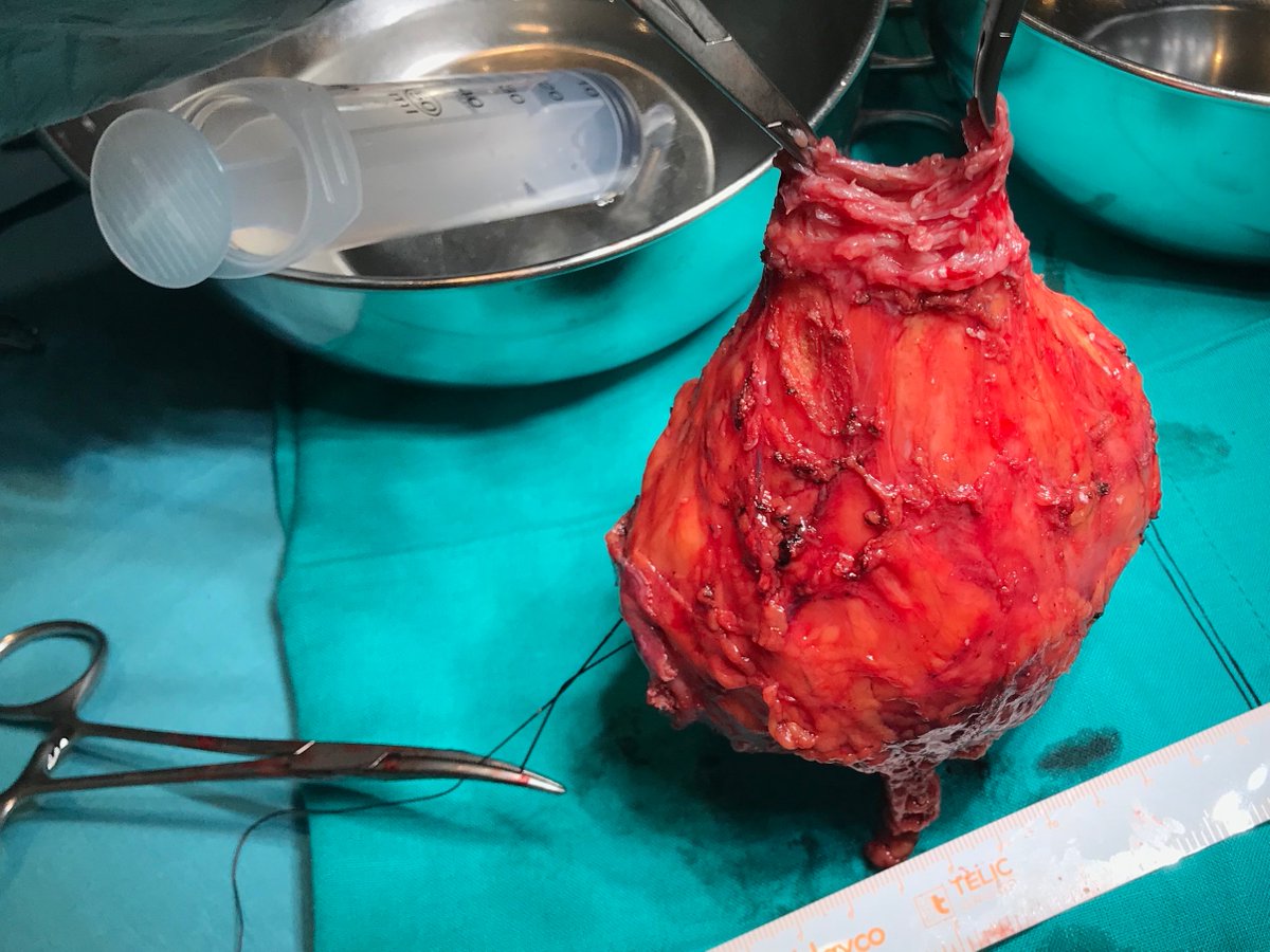 uroServera's tweet photo. Ya está online el vídeo de nuestra técnica de diverticulectomía laparoscópica. Muy orgullosos del premio  recibido en Barcelona en #LELR20.

https://t.co/04LUtM0i52

#urology 
#laparoscopia
#urologiamallorca
#surgery https://t.co/D9s6Mdlyo9