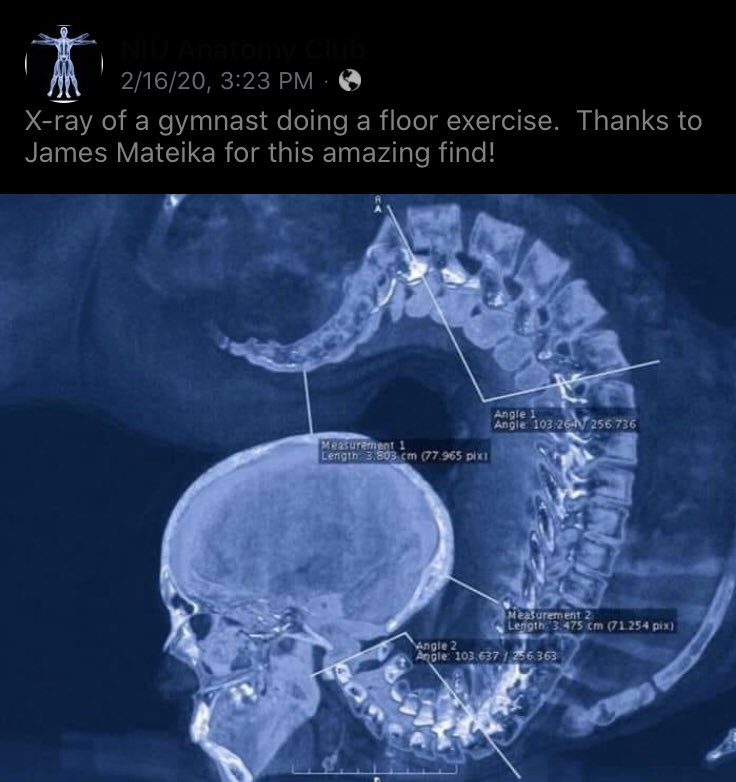 GailB_DPT's tweet photo. Today one of my students asked about the potential harmful forces on the spine when transitioning from quadruped to high kneeling... wish I had this pic 😂 The spine is meant to move!!! #PT #MovementExperts https://t.co/qIsbCVdPaz