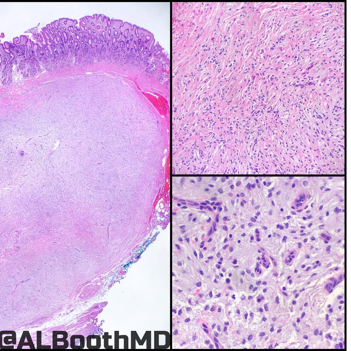 ALBoothMD's tweet image. Plexiform fibromyxoma
🔸multinodular/plexiform
🔸arise in gastric muscularis propria
🔸bland oval/spindle cells
🔸myxoid/fibromyx/collagenou stroma
🔸prominent capillaries
🔸SMA+/Desmin-/C-kit-/DOG1-
🔸MALAT1-GLI1 fusion
🔸ddx: GIST/IFP/Schwannom/neurofibr
#gipath