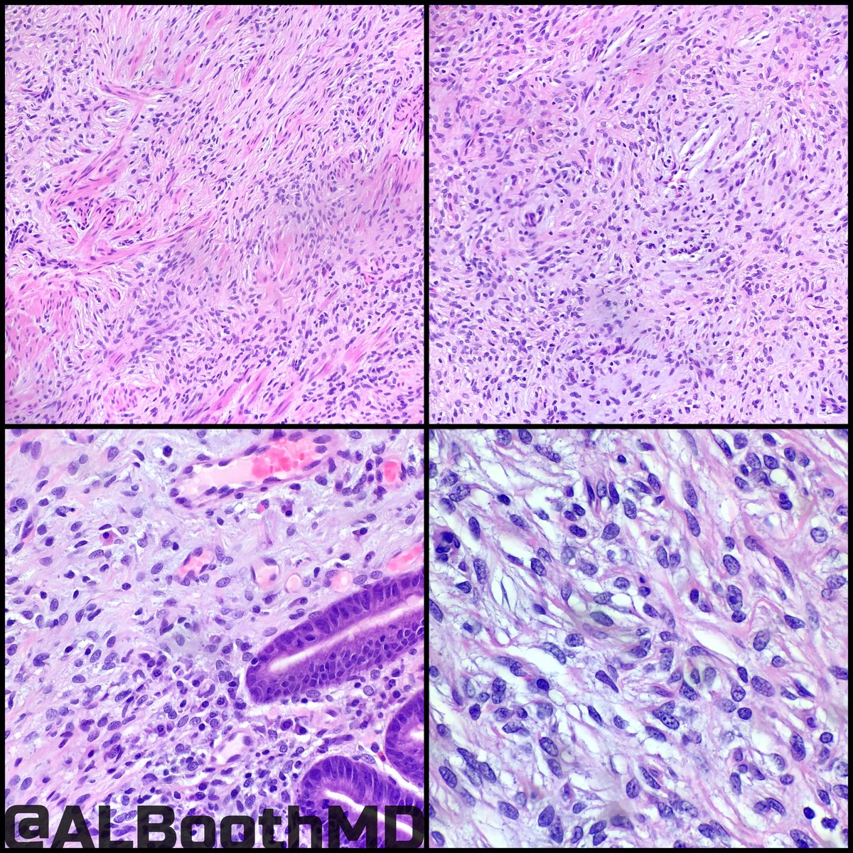 ALBoothMD's tweet image. Plexiform fibromyxoma
🔸multinodular/plexiform
🔸arise in gastric muscularis propria
🔸bland oval/spindle cells
🔸myxoid/fibromyx/collagenou stroma
🔸prominent capillaries
🔸SMA+/Desmin-/C-kit-/DOG1-
🔸MALAT1-GLI1 fusion
🔸ddx: GIST/IFP/Schwannom/neurofibr
#gipath