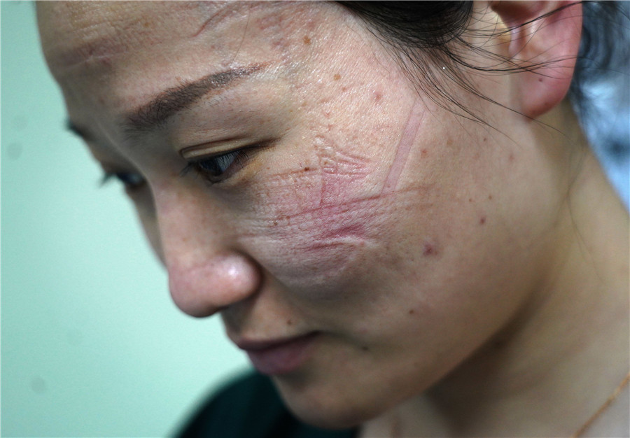 China Daily on X: Images of imprints left by goggles and masks of front  line medical workers after working long hours have moved many online. The  first batch of 6,000 protective patches