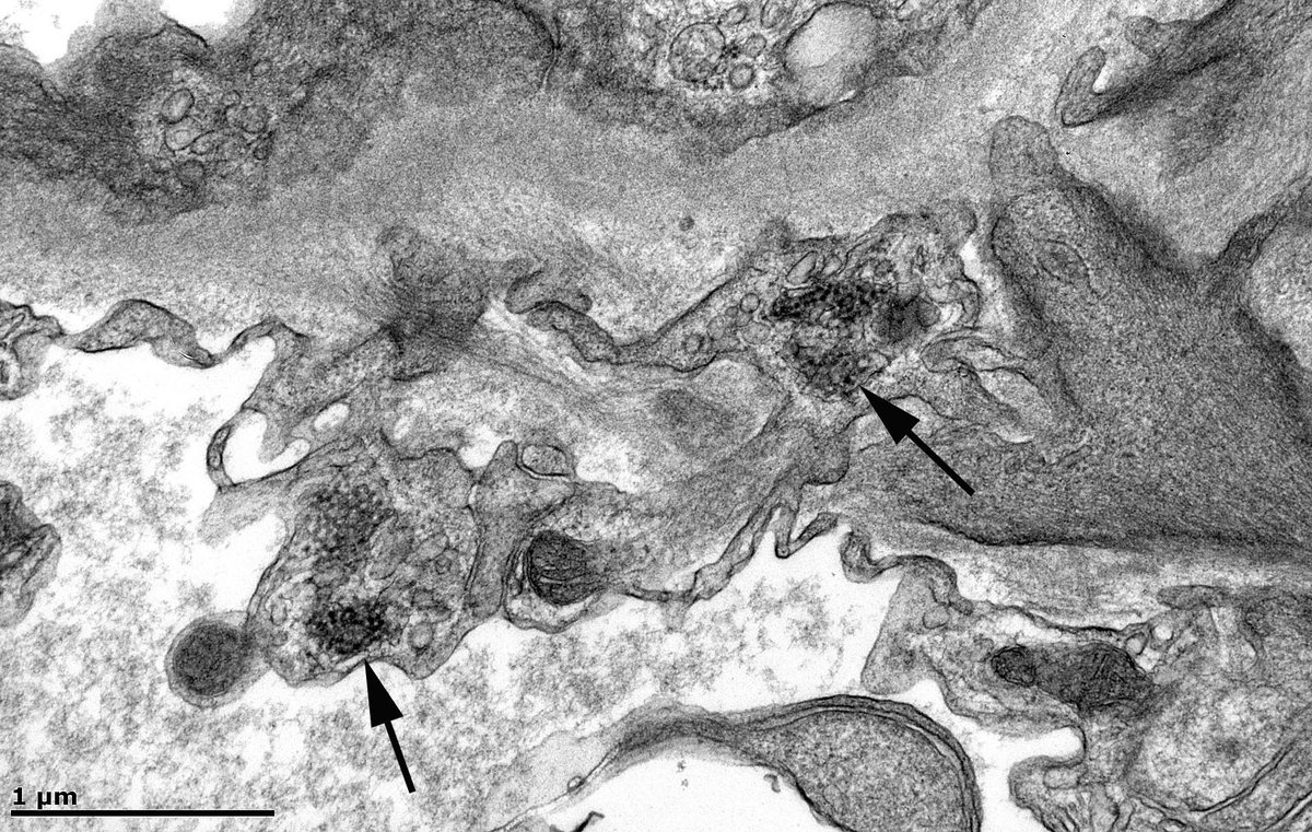 JohnBrealey's tweet photo. 46F with minimal change disease (MCD). Plentiful tubuloreticular inclusions (TRI) in glomerular endothelial cells (image 2), lymphocytes (image 3) and peritubular capillary endothelial cells (image 4). Do the TRIs suggest a secondary form of MCD? Could there be a viral infection? https://t.co/KgXDpUAyVa