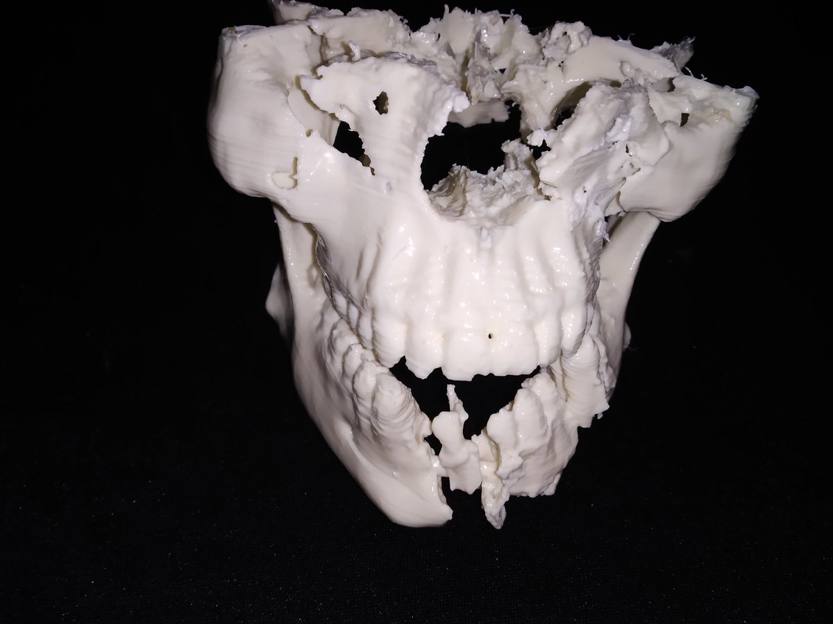 MM3D_'s tweet photo. Mandíbula y maxilar superior realizados en impresión 3d para estudio pre quirúrgico. #dentista #maxilofacial #mandibula #maxilar #planificacionquirurgica #impresion3d #3dprinting #3dmodel https://t.co/XrgH5hdQGB