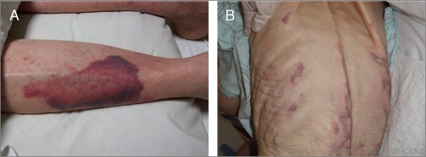 aswcjournal's tweet photo. Reexamining the Literature on Terminal #Ulcers, SCALE, #SkinFailure, and Unavoidable #PressureInjuries.
https://t.co/Y99GSnRz3H https://t.co/MlPLJJw42W
