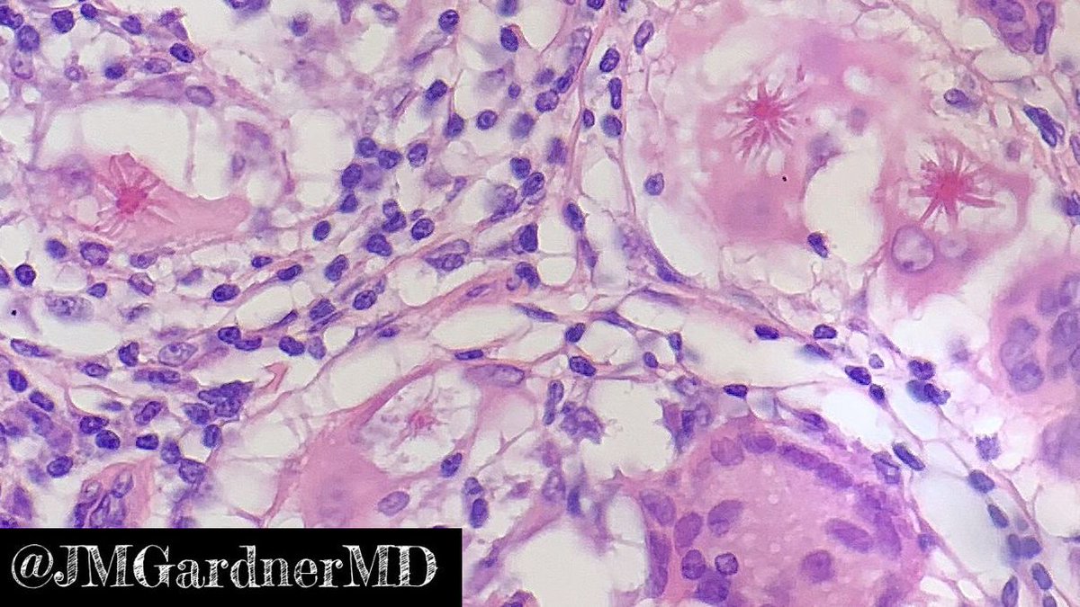 JMGardnerMD's tweet photo. What do you call a group of asteroid bodies? A constellation! πππThank you ladies & gentlemen! Iβll be here all week! Seriously though...4 in one field! π₯PS - this was from a foreign body Granuloma not sarcoidosis. #DadJoke #PathJoke #pathology https://t.co/P04H7GU4Oa