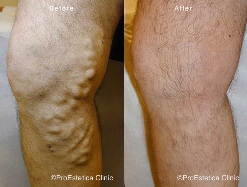 a_medart's tweet photo. Endovenous Laser Therapy by MedArt ILVO @ProEsteticaClinic 👍&amp; appreciated Dr. Stefan Jianu to share the great result 🙏🏻💐👏Varicose veins affect approximately 15-30% of the population, increasing with age. Laser therapy is a fast &amp;effective treatment. #vascularsurgeon #varicose https://t.co/bVGvHYRCst