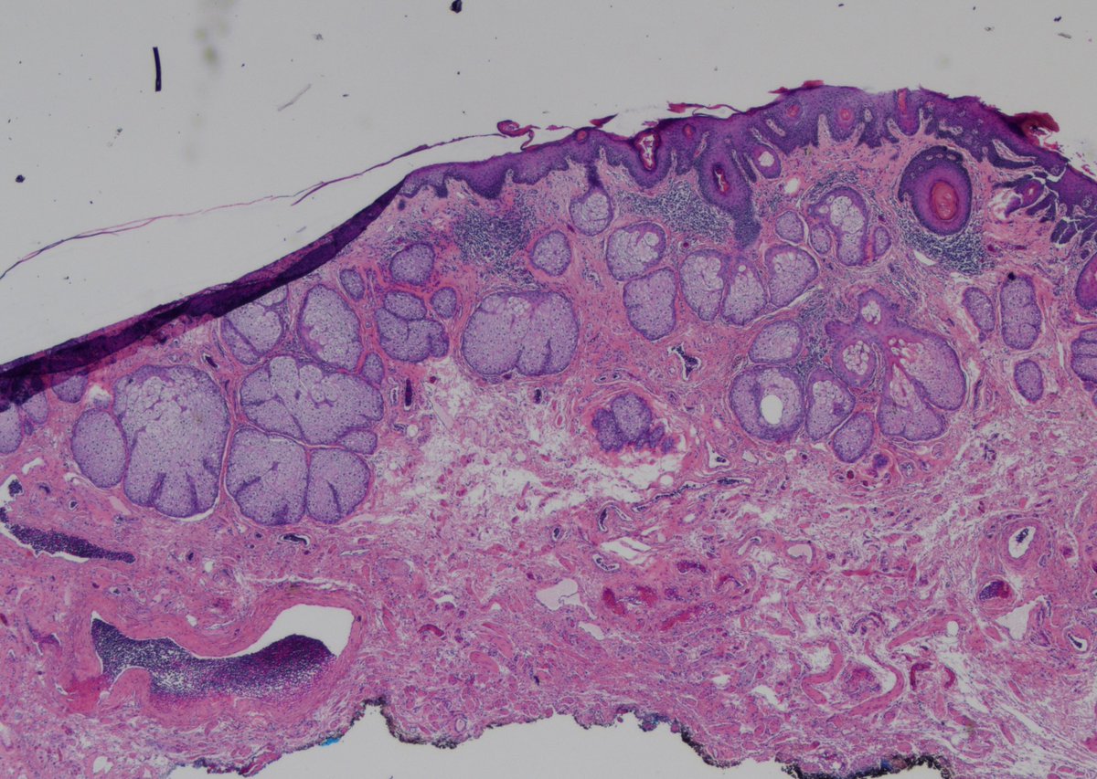 rajalbshah's tweet image. Fordyce granules. Foreskin from a 30-year-old presenting with Phimosis. These are ectopic sebaceous glands characterized by yellowish white popular lesions.Typically occurs in oral cavity but can also occur in penis! @UTSW_GUPath