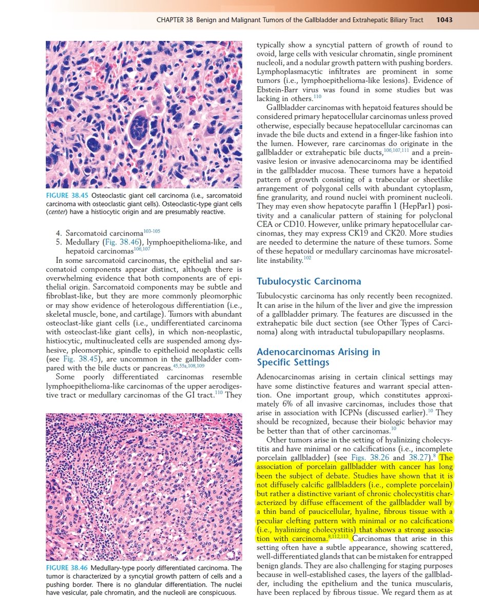 Elderly. Gall bladder of a patient with Klatskin tumour. Hyalinizing cholecystitis 'incomplete porcelain gallbladder' - not much calcification. Screencap from Odze and Goldblum Surgical Pathology of the GI Tract, Liver, Biliary Tract ... #gipath ncbi.nlm.nih.gov/pubmed/21716080