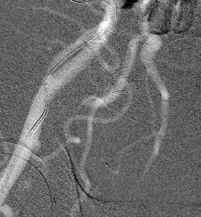 #TRAS found in patient with rising creatinine. Successful PTA with CO2 @EmoryRadiology <a href="/EmoryIRad/">Emory University Interventional Radiology</a> <a href="/angiowoman/">Janice Newsome MD FSIR</a> <a href="/DrGailPeters/">Dr. Gail Peters</a> @billmajdalany <a href="/MCristMD/">Mircea Cristescu</a> <a href="/NimaKokabiMD/">Nima Kokabi MD</a> @ZachBercuMD <a href="/judywawira/">Judy Gichoya</a> <a href="/JulieCronan1/">Julie Cronan</a> <a href="/DrDukesVIR/">Aaron DuCoffe, MD</a> <a href="/JoeHenain/">Joe Henain</a> #TwittIR #minimallyinvasive #irad