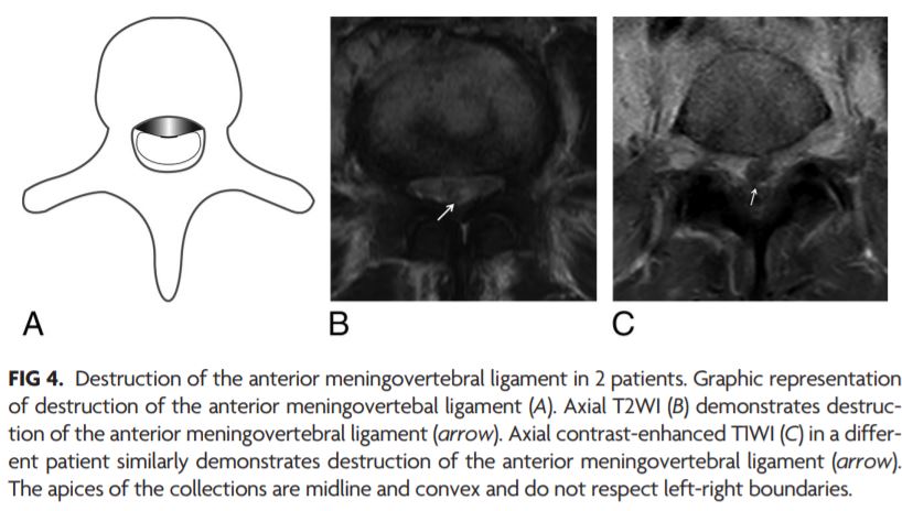 AJNR (@theajnr) on Twitter photo "Differentiation between Tuberculous and Pyogenic Spondylodiscitis The Role of the Anterior Meningovertebral Ligament in Patients with Anterior Epidural Abscess" | #Neurorad #Spine | <a href="/ShiraSlaskyMD/">Shira Slasky</a> bit.ly/2vaRKH9 "Differentiation between Tuberculous and Pyogenic Spondylodiscitis The Role of the Anterior Meningovertebral Ligament in Patients with Anterior Epidural Abscess" | #Neurorad #Spine | <a href="/ShiraSlaskyMD/">Shira Slasky</a> bit.ly/2vaRKH9