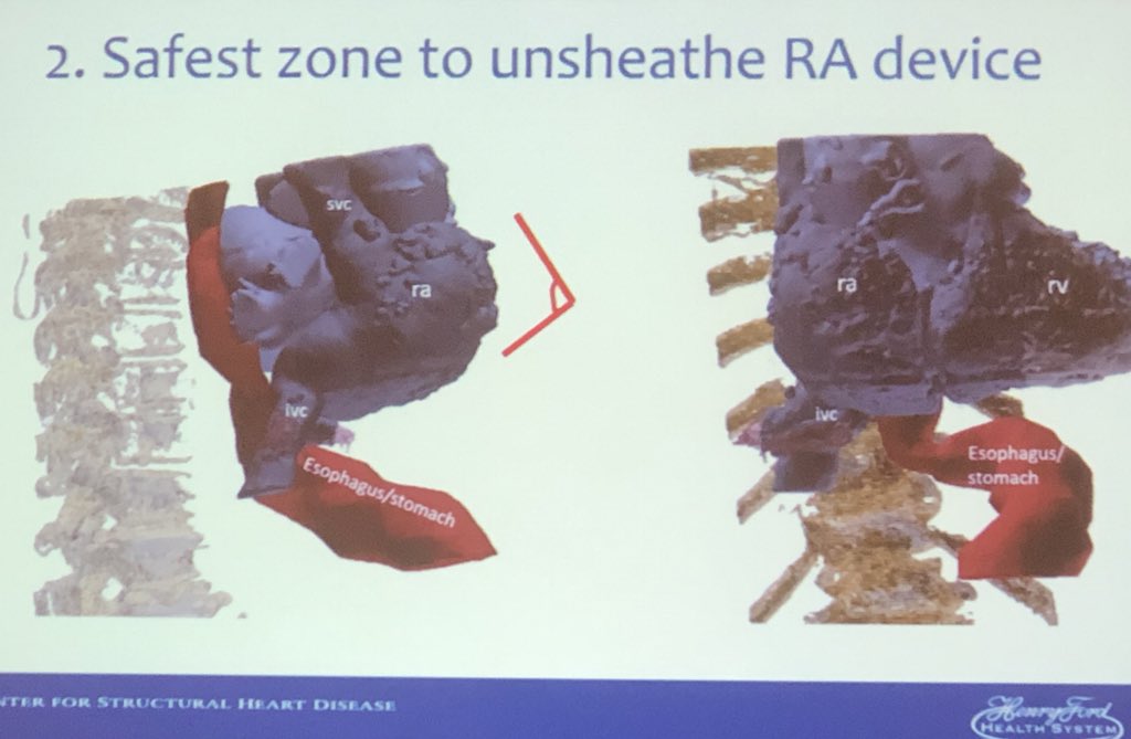 hvanspall's tweet photo. @DeeDeeWangMD on #YesCT for #mitral & #tricuspid interventions. Can highlight anatomy to avoid intraprocedural complications. #CRT2020 @mirvatalasnag @AChoiHeart @HeartOTXHeartMD @CaraCarahendry @mmamas1973 @DrMarthaGulati @onco_cardiology @rajdoc2005 #Interventionalimaging https://t.co/u71U65OdSP