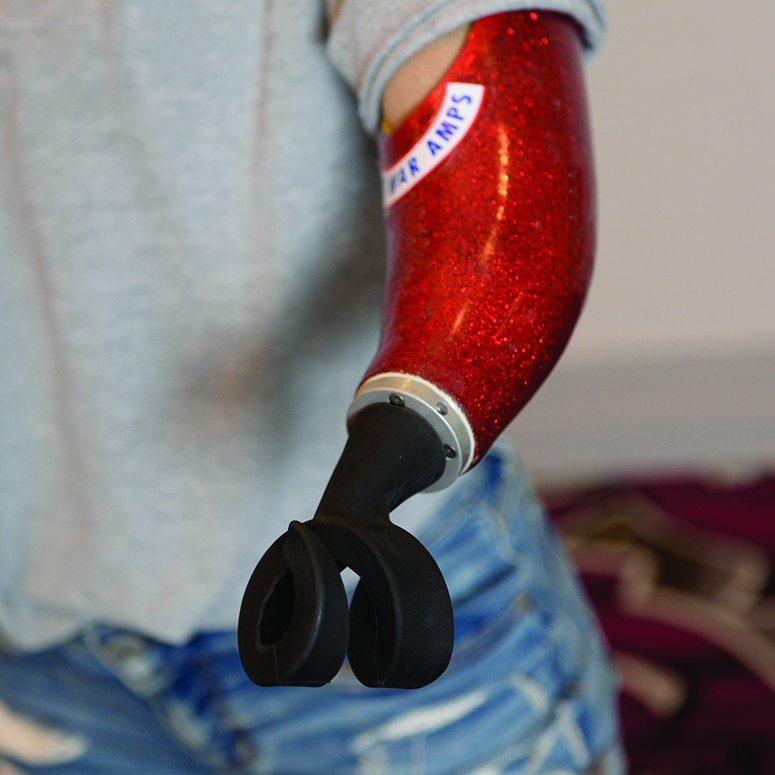 TheWarAmps's tweet image. Carly, whose amputation is at the elbow joint, loves curling with her new arm. Her curling broom goes through the spiral device at the end of her arm, which is made shorter than usual to give her more control. 🥌  #curlingday