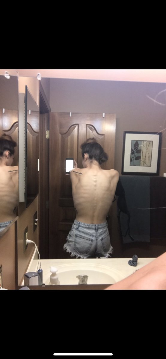 KenzieBull1's tweet image. #edawarenessweek I promise you, your weight does not define your worth. Recovery is the hardest thing I’ve ever gone through &amp;amp; am still going through but hopefully,one day, I will be able to accept myself in the skin I’m in, because I’m more than what numbers appear in the scale