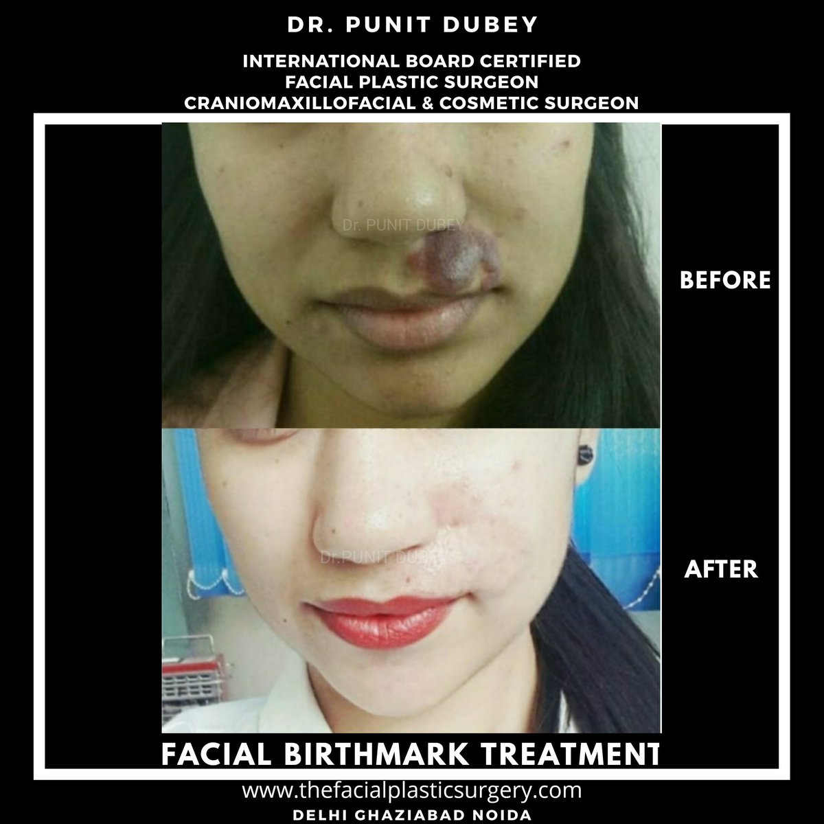 DrPunitDubey's tweet photo. Facial Birthmark involving half of upper lip treated using local Facial Flap.
Learn more about Facial Birthmarks.
#craniomaxillofacialsurgeon #facialbirthmark #facialbirthmarktreatment #plasticsurgery #facialplasticsurgeon #drpunitdubey #delhi #india https://t.co/Q82ScrkrcG