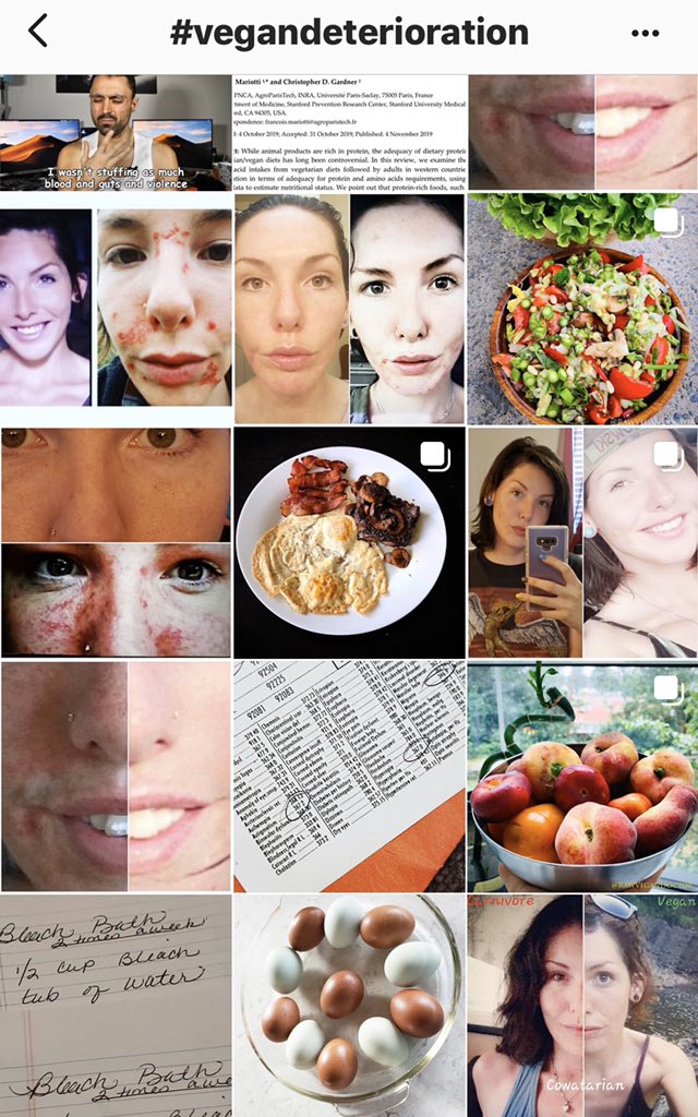 VeganRecovering's tweet image. Just look at Instagram. I had the same issues as these ex-vegans--red sores on my face, weak nails, balding hair, horiffic autoimmune issues. It doesn't miraculously all heal. Some of the damage is permanent. Many #exvegans feel betrayed by phony influencers who lied to us!