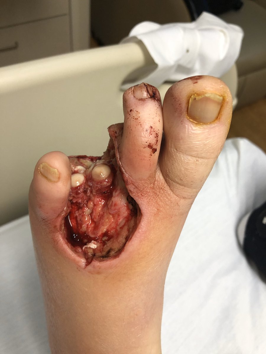 wounddoctor1's tweet image. Pre and post-op diabetic foot infection, transmetatarsal amputation. #savealimb, #diabetes, #wound, #surgery