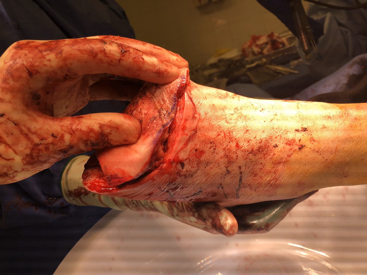 wounddoctor1's tweet image. Pre and post-op diabetic foot infection, transmetatarsal amputation. #savealimb, #diabetes, #wound, #surgery