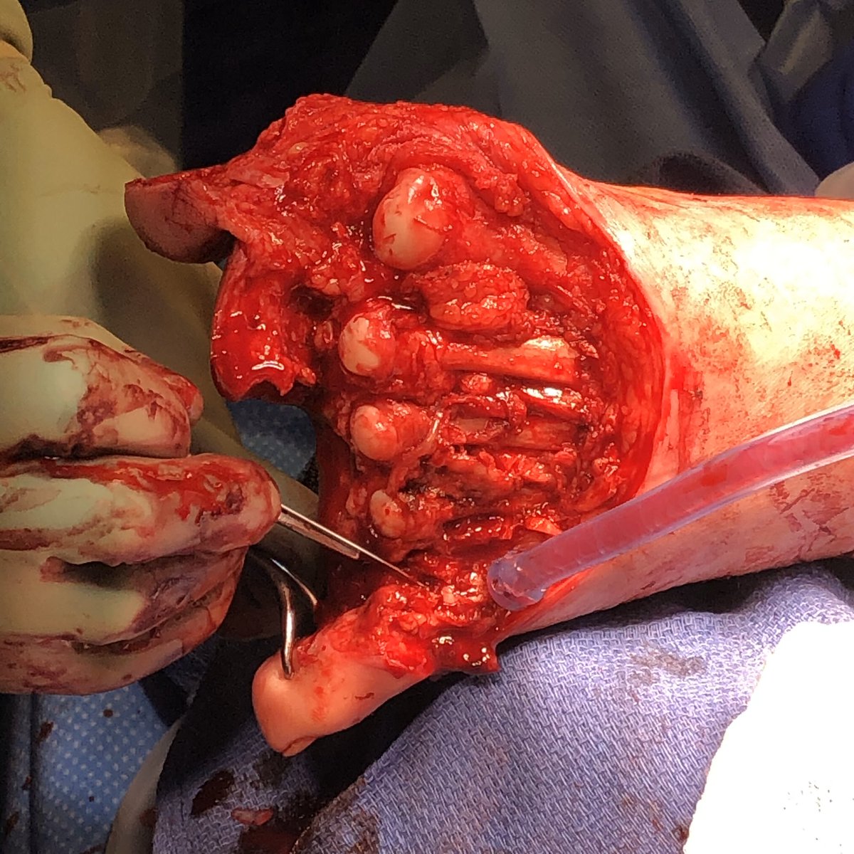 wounddoctor1's tweet image. Pre and post-op diabetic foot infection, transmetatarsal amputation. #savealimb, #diabetes, #wound, #surgery