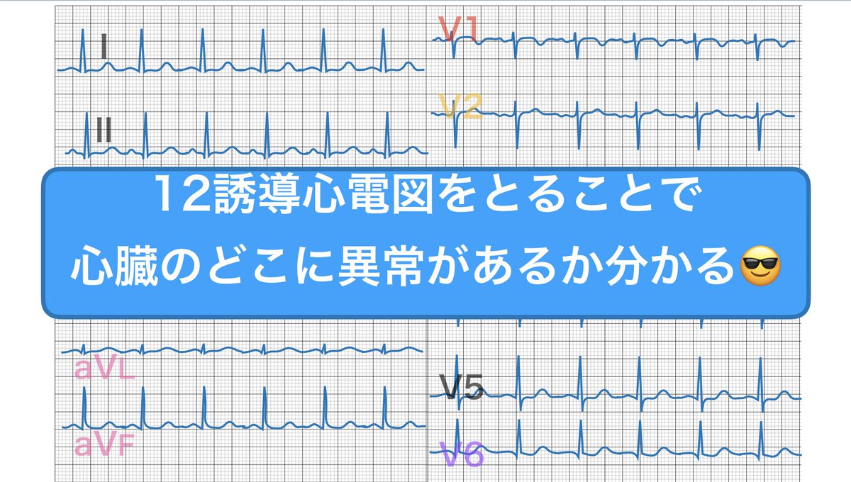 KuntaJo's tweet photo. 心電図は難しいけど

3誘導👉心臓の大まかな動き＆リズムを見ているだけ
（実際3誘導だとあまり細かいことまで分からない）

12誘導👉心臓をあらゆる方向(12方向)から見る。
（正確にどこが障害されているのか分かる）

12誘導は考えずに目で見て覚えるのがいいよ👍

ちょっと資料作ってみたから見て👀 https://t.co/fNIC7B3Pud