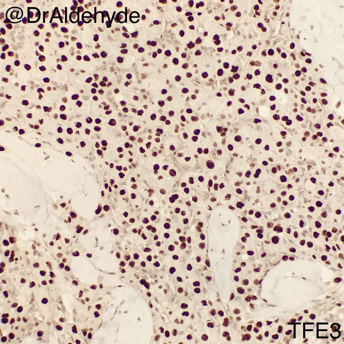 #USCAP2020 special. 😆🔬

Not so much of “alveolar” architecture in this particular case, but it’s okey - it’s still alveolar soft part sarcoma. Another great example that tumors don’t read a book. 

Look forward to meeting with you all in LA! 

#BSTPath #Pathology #LosAngeles