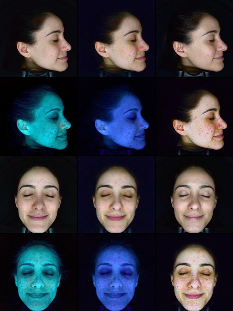 mayfairpractice's tweet photo. Many skin conditions that surface in time originate from the deeper skin layers and are difficult to diagnose with the human eye. Book a skin consultation to get to the bottom of your skin concerns! ✨ https://t.co/fH60MPJfue https://t.co/YLHaAcQJXJ