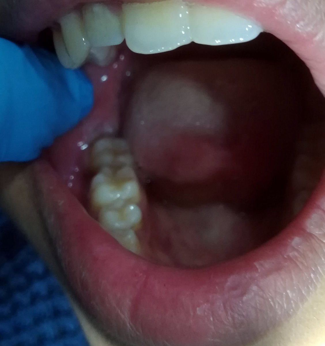 hesham_abdo1's tweet photo. First impaction done from A - Z by me 👍
Lower right 8 partially impacted
(Carious)
Steps
1:inferior alveolar nerve block injection
2: envelope flap
3: elevation of the flap with mucoperosteal elevator
4:Guttering technique to remove the lock
5: Coupland elevator for extraction⤵️ https://t.co/ErZyX9TPCR