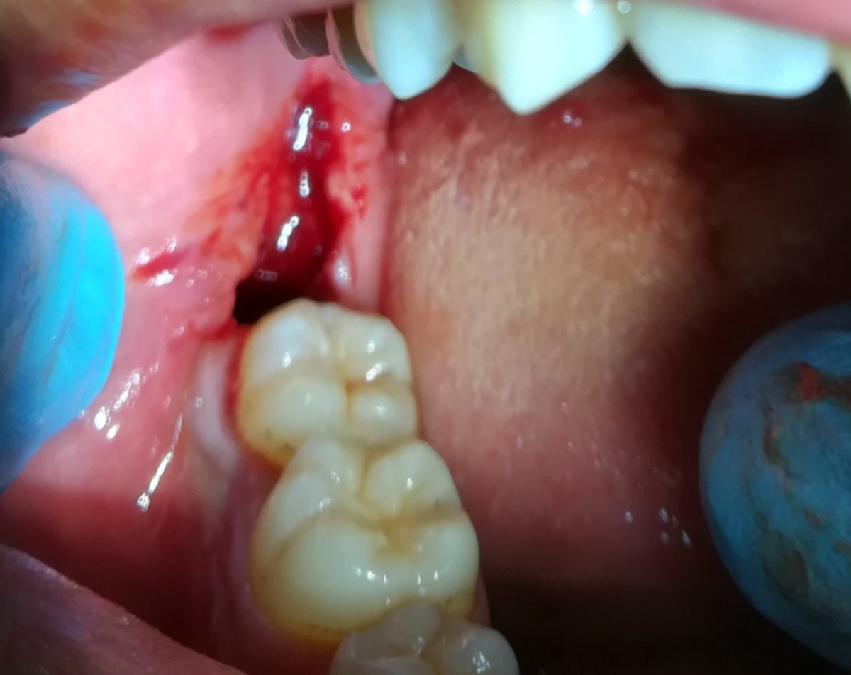 hesham_abdo1's tweet photo. First impaction done from A - Z by me 👍
Lower right 8 partially impacted
(Carious)
Steps
1:inferior alveolar nerve block injection
2: envelope flap
3: elevation of the flap with mucoperosteal elevator
4:Guttering technique to remove the lock
5: Coupland elevator for extraction⤵️ https://t.co/ErZyX9TPCR