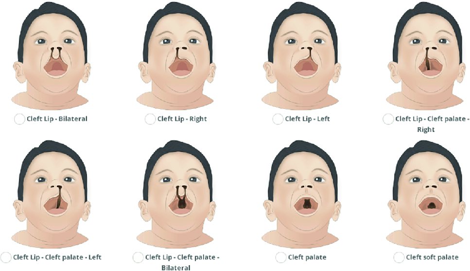 GoodDoctor18's tweet photo. A cleft palate often includes a split (cleft) in the upper lip (cleft lip) but can occur without affecting the lip.

#medical_student #فضفضة_طالب_طب #فضفضة_طبيب #لست_وحدك https://t.co/DR9C1CcAcx