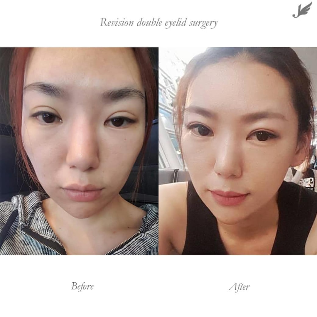 Jw ジョンウォン美容外科 Jwsurgerykorea Twitter